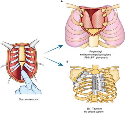 The sternum reconstruction: Present and future perspectives